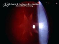 Typical flower-shaped cortical lens opacity.